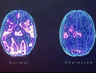 فلوکستین : کاربردها ، عوارض و ... 