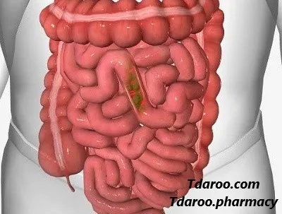 رفع اسهال با لوپرامید 