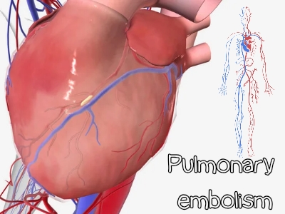 چرا باید آمبولی ریوی را جدی بگیریم؟