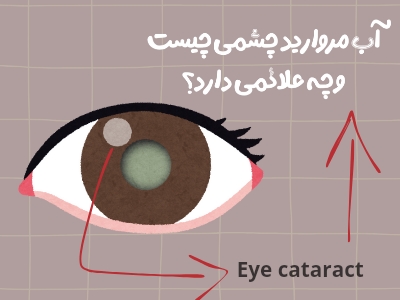 تغذیه و تاثیر آن بر آب مروارید چشمی