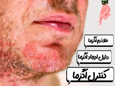 اگزما و چگونگی کنترل و درمان